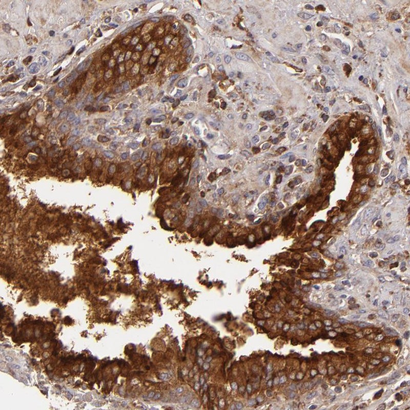 Immunohistochemical staining of human prostate shows strong cytoplasmic and membranous positivity in glandular cells.
