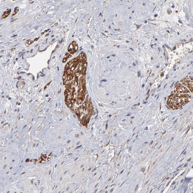 Immunohistochemical staining of human prostate shows strong positivity in peripheral nerves. 