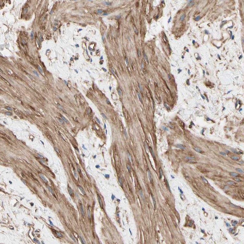 Immunohistochemical staining of human smooth muscle shows cytoplasmic positivity in smooth muscle cells.