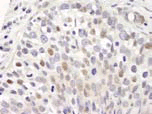 抗hSET1 抗体を用いたヒト胸腺癌のホルマリン固定パラフィン包理切片の免疫組織染色像