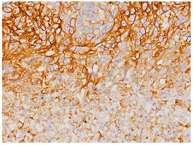 抗PD-L1抗体による肺がん組織の染色像