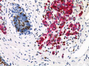 メラノーマの免疫染色像