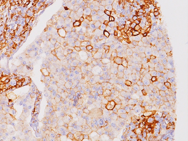抗PD-L1抗体によるメラノーマの染色像