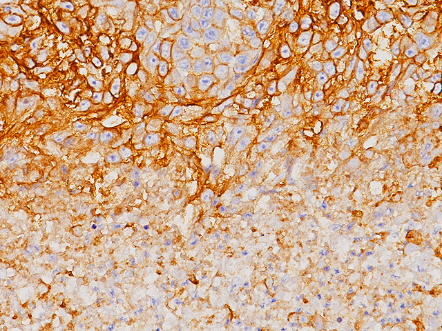 抗PD-L1抗体による肺がん組織の染色像