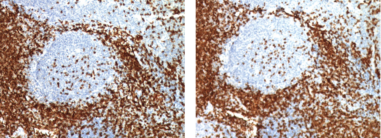MACH1免疫染色-扁桃腺組織のCD3