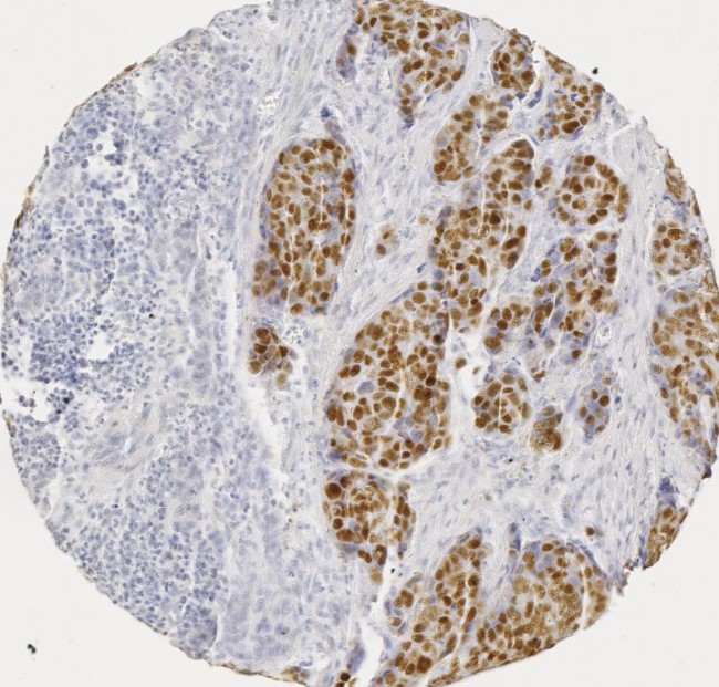 抗ヒトp53マウス抗体を用いたヒト扁平上皮がんの組織染色