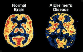 アルツハイマー型認知症患者の脳との比較画像