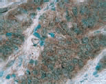 ヒト神経芽細胞腫組織の免疫組織染色像