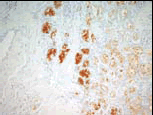 DAB とヘマトキシリンで対比染色した抗 Lung Squamouscarcinoma抗体（#TM14）の染色像。