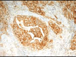 DAB とヘマトキシリンで対比染色した抗 Sialyl Lewisa 抗体（#TM06）の染色像。