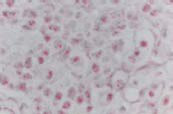Her-2/Neu プローブを用いてデュアルカラー CISH 染色した乳癌組織