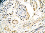 抗Salusin-α抗体を用いたヒト副腎髄質過形成組織のIHC像