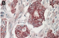抗 Akt 抗体（#100-401-401）を用いた結腸腫瘍組織の免疫組織染色像