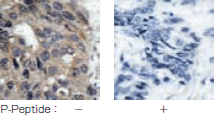 抗Src（pTyr529）抗体（#11153）を用いた、パラフィン包埋ヒト乳癌組織の免疫組織染色画像