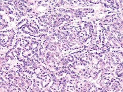 ヒト癌組織から抽出したtotal RNAおよびtotal DNA TissueFocus Purified RNA and DNA 由来であるヒト腎臓癌の組織染色画像（20×）