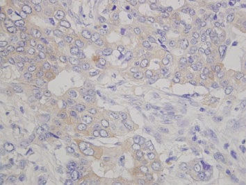 ホルマリン固定パラフィン包埋ヒト膵がん組織の本製品による免疫染色像