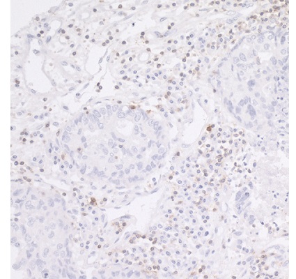 肺癌におけるヒトCD247 / CD3Zの免疫染色像