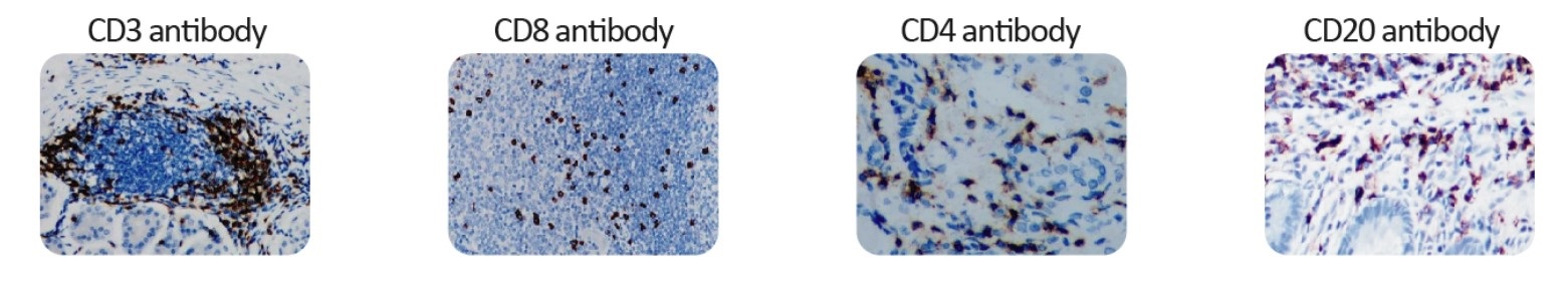 Tumor-infiltrating Lymphocyte Antibody Panelの使用例
