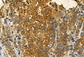 抗リン酸化IRE1（Ser724）抗体（#AF7150、1/100希釈）＋HRP標識抗ウサギIgG抗体を用いたヒト乳がん組織パラフィン包埋切片の免疫組織染色像