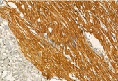 抗リン酸化IRE1（Ser724）抗体（#AF7150、1/100希釈）＋HRP標識抗ウサギIgG抗体を用いたヒト膵臓がん組織パラフィン包埋切片の免疫組織染色像