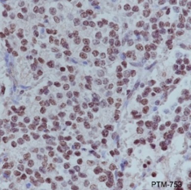 Anti-Pohspho-Histone  H2A.X（Ser139）, Mouse-Mono（#PTM-753、1/500倍希釈）を用いたホルマリン固定パラフィン包埋ヒト神経芽腫組織切片の免疫染色像