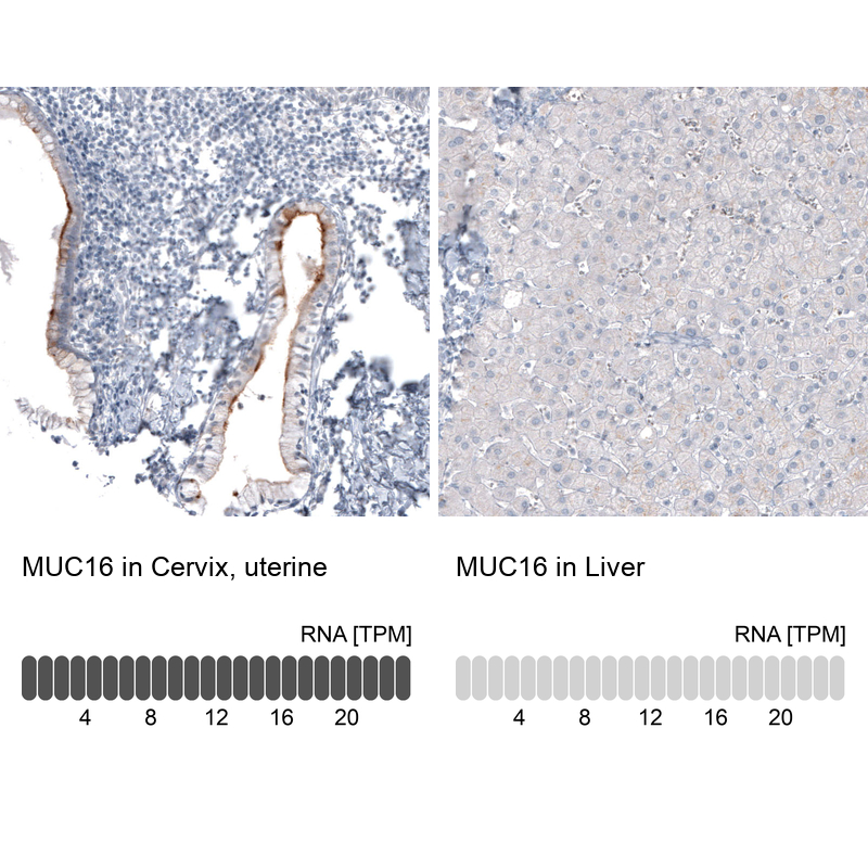 抗MUC16（CA125）抗体（#AMAb91056）のIHC像