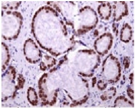 抗ヒトNKX3.1抗体（#0317）を用いて染色された軟部組織転移