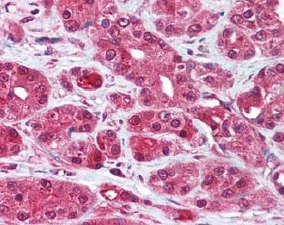 抗MMP-7抗体（#AS-29577）を用いたヒト前立腺がんの免疫染色像
