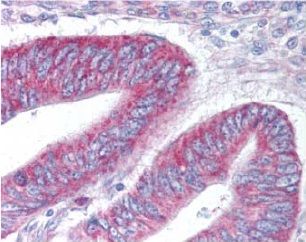 抗MMP-10抗体（#AS-29580）を用いたヒト結腸がんの免疫染色像