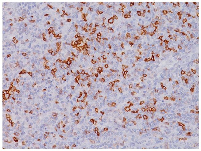 抗PD-1抗体によるヒトメラノーマの染色像