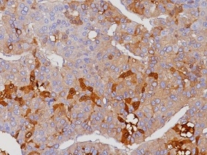 抗AFP抗体を用いた肝臓がんの免疫染色画像