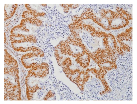 抗MLH-1抗体（#APR220AA）を用いた結腸がん組織の免疫染色像