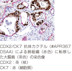 CDX2/CK7抗体カクテル免疫染色図