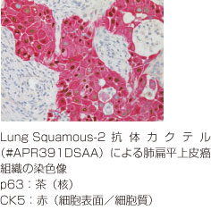 Lung Squamous-2抗体カクテル免疫染色図