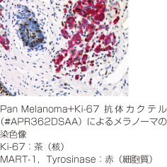 Pan Melanoma + Ki-67抗体カクテル免疫染色図