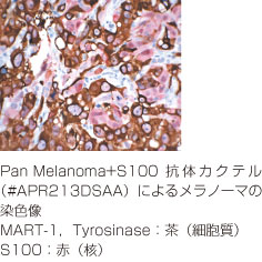 Pan Melanoma + S100抗体カクテル免疫染色図