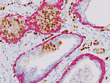 ヒト前立腺癌とERG陽性前立腺上皮内腫瘍の免疫染色像