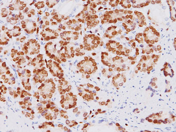 前立腺癌の免疫染色像