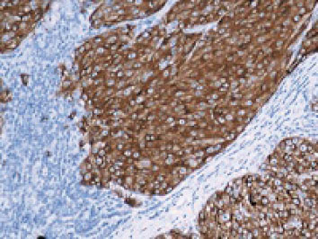 抗MART-1によるメラノーマの免疫染色像