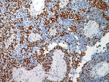 抗MiTF抗体による転移性メラノーマの免疫染色像