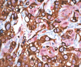 Pan Melanoma＋S100抗体カクテルによるメラノーマの染色像