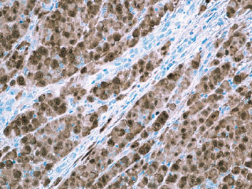 抗S100抗体（#ACR021A）によるメラノーマ染色像