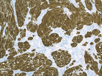 抗S100抗体カクテル（#ACR089A）によるメラノーマ染色像