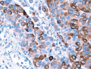抗Tyrosinase抗体（#ACR155A）によるメラノーマ染色像