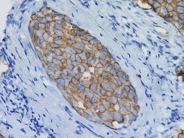 #PME342AAによる乳がん組織の免疫染色像