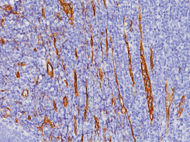 抗CD34抗体を用いた隆起性皮膚線維肉腫の免疫染色像