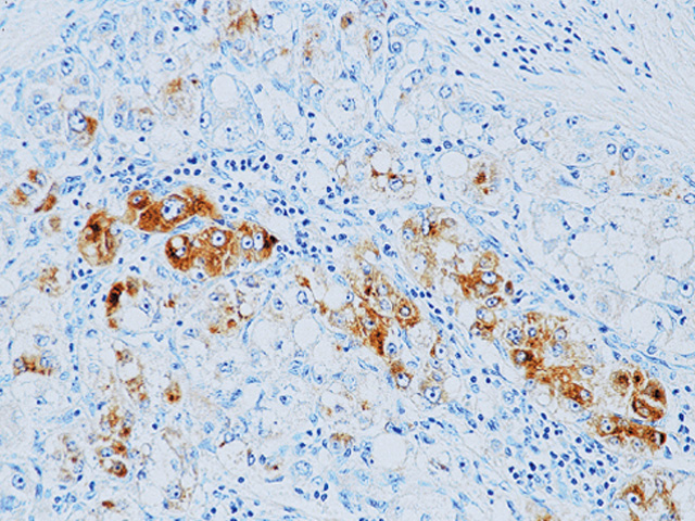抗α-1-Fetoprotein抗体（#ACR028A）による肝臓がん組織の免疫染色像