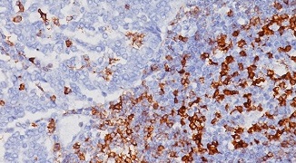 PD-1 乳がん