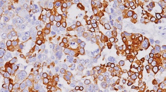 Cytokeratin 7 (CK7) 乳がん