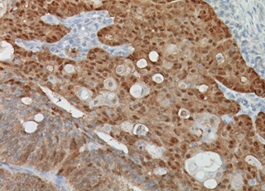 β-Catenin 結腸腺がんの免疫染色像